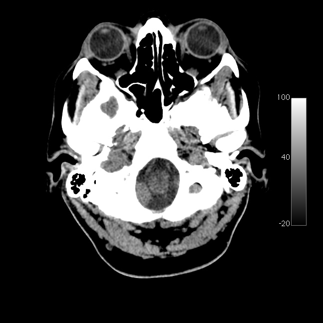 Caroticocavernous fistula (Radiopaedia 14617-14542 Axial non-contrast 1).jpg