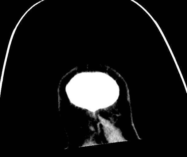 Carotid arterial dissection (Radiopaedia 30001-30549 Coronal non-contrast 50).jpg