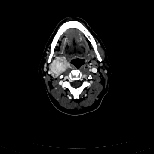 Carotid body tumor (Radiopaedia 83615-98727 D 53).jpg
