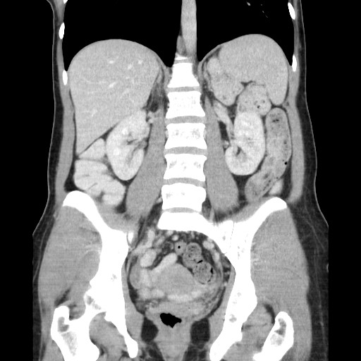 File:Castleman disease with fibrous pseudotumor in the abdomen (Radiopaedia 77296-89373 B 58).jpg