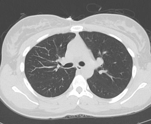 File:Catamenial pneumothorax (Radiopaedia 54382-60600 Axial 13).png