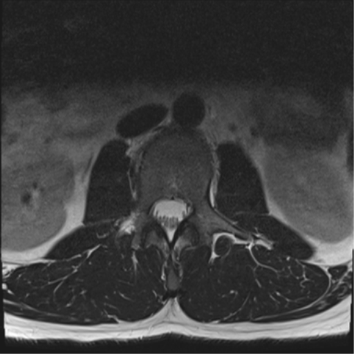 File:Cauda equina syndrome (Radiopaedia 53615-59672 Axial T2 30).png