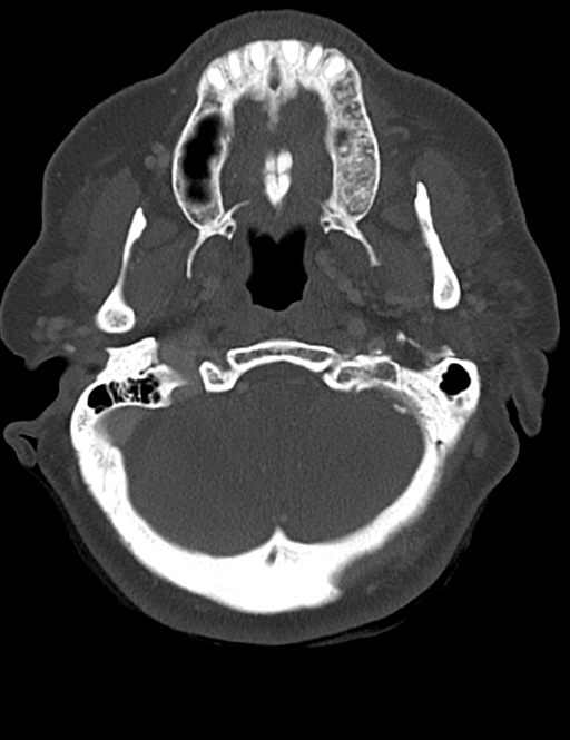 Causes of dysphagia (Radiopaedia 40149-42657 Axial bone window 11).png