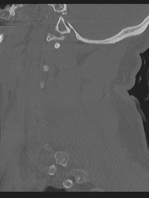 Cavernoma of cervical cord (Radiopaedia 50838-56346 Sagittal bone window 21).png