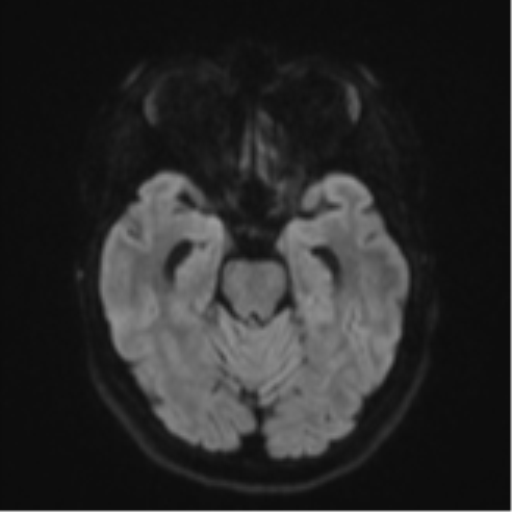 File:Cavernoma with bleed - midbrain (Radiopaedia 54546-60774 Axial DWI 37).png