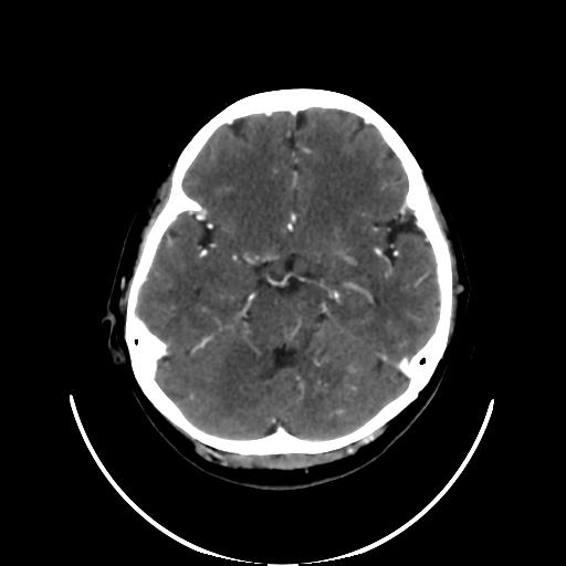 File:Cavernoma with developmental venous anomaly (Radiopaedia 22470-22506 C+ arterial phase 14).jpg