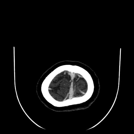 Cavernoma with developmental venous anomaly (Radiopaedia 22470-22506 C 193).jpg