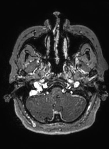 Cavernous hemangioma of the cerebellar falx (Radiopaedia 73025-83724 Axial T1 C+ 294).jpg