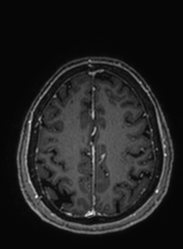 File:Cavernous hemangioma of the cerebellar falx (Radiopaedia 73025-83724 Axial T1 C+ 90).jpg