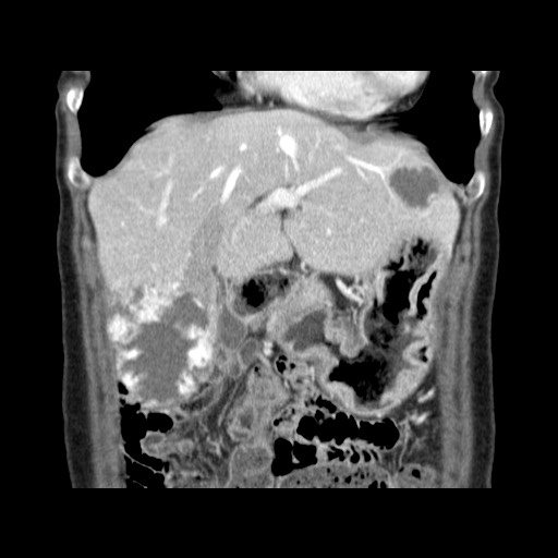 Cavernous hepatic hemangioma (Radiopaedia 75441-86667 C 43).jpg