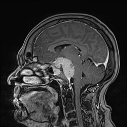 Cavernous sinus meningioma (Radiopaedia 63682-72367 Sagittal T1 C+ 88).jpg