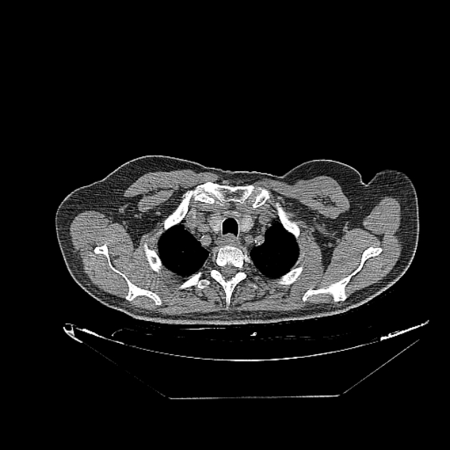 Cavitating bronchogenic carcinoma (Radiopaedia 44489-48162 Axial non-contrast 6).jpg