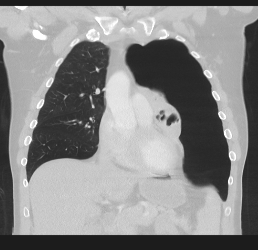 File:Cavitating pneumonia complicated by pneumothorax (Radiopaedia 48149-52994 Coronal lung window 23).png