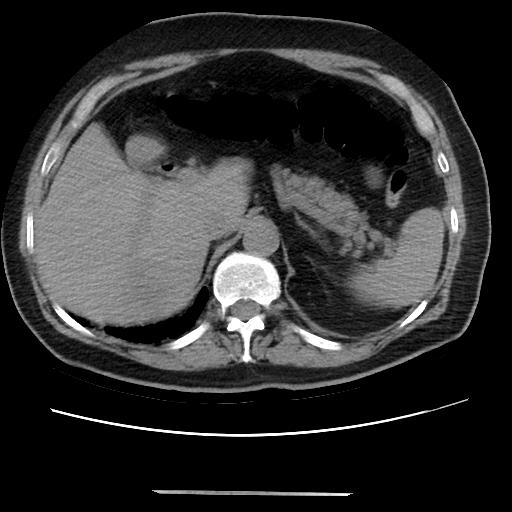 Cavitating pulmonary metastases (Radiopaedia 89545-106544 Axial non-contrast 55).jpg