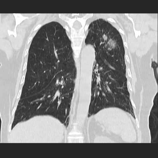 File:Cavitating pulmonary metastases (Radiopaedia 89545-106544 Coronal lung window 29).jpg