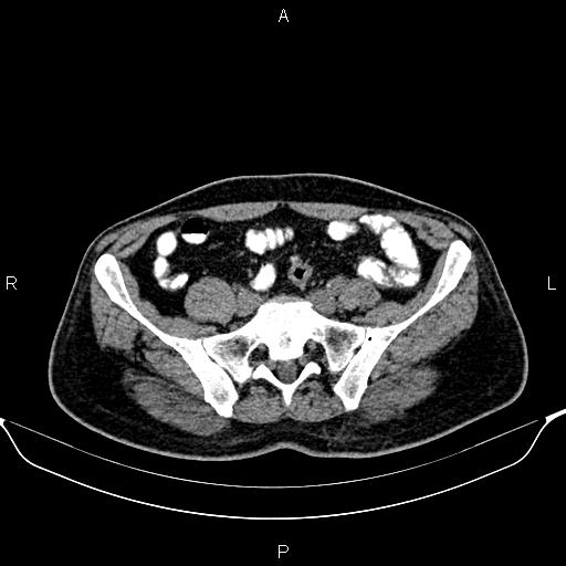 File:Cecal adenocarcinoma (Radiopaedia 85324-100916 Axial non-contrast 71).jpg