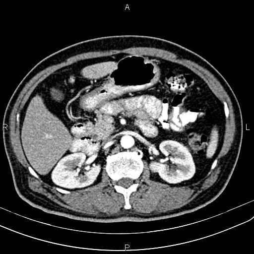Cecal cancer with appendiceal mucocele (Radiopaedia 91080-108651 A 78).jpg
