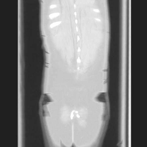 Cecal volvulus (Radiopaedia 75378-86620 Coronal lung window 125).jpg