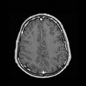 Central-variant posterior reversible encephalopathy syndrome (PRES) (Radiopaedia 43880-47358 Axial T1 C+ 123).jpg