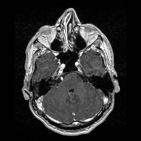 File:Central-variant posterior reversible encephalopathy syndrome (PRES) (Radiopaedia 43880-47358 Axial T1 C+ 36).jpg