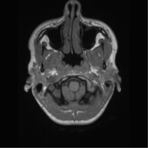 File:Central neurocytoma (Radiopaedia 37664-39557 Axial T1 6).png