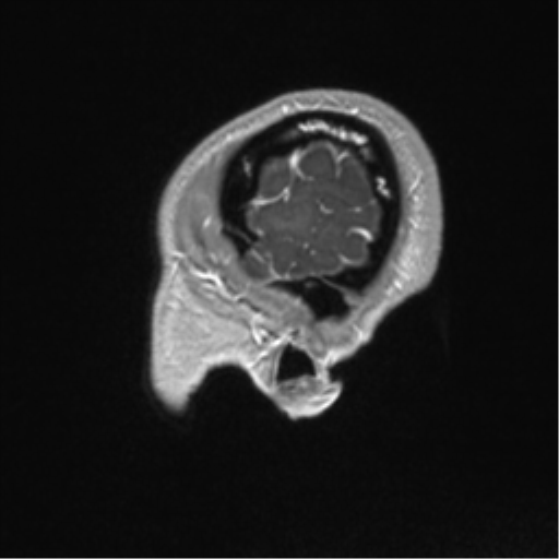 Central neurocytoma (Radiopaedia 37664-39557 Sagittal T1 C+ 11).png