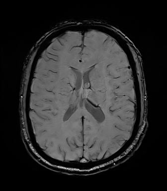 File:Central neurocytoma (Radiopaedia 71068-81303 Axial SWI 38).jpg