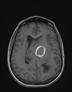 File:Central neurocytoma (Radiopaedia 84497-99872 Axial T1 122).jpg