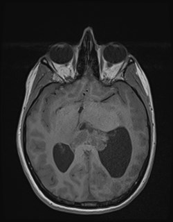 Central neurocytoma (Radiopaedia 84497-99872 Axial T1 95).jpg