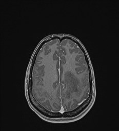 File:Central neurocytoma (Radiopaedia 84497-99872 Axial T1 C+ 118).jpg