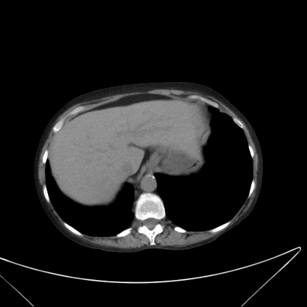 Centrilobular pulmonary emphysema (Radiopaedia 24495-24789 Axial non-contrast 42).jpg