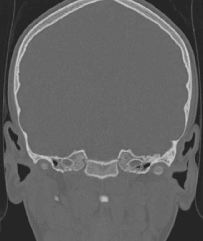 Cerebellar abscess (Radiopaedia 73727-84527 Coronal bone window 81).jpg