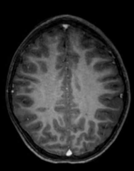 Cerebellar abscess (Radiopaedia 73727-84563 Axial T1 C+ fat sat 79).jpg