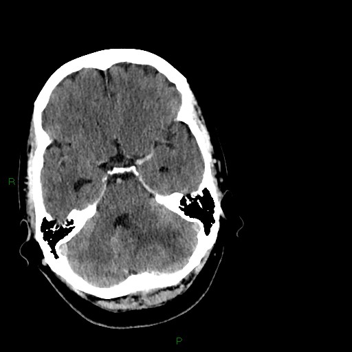 Cerebellar abscess (Radiopaedia 78135-90671 Axial C+ delayed 34).jpg