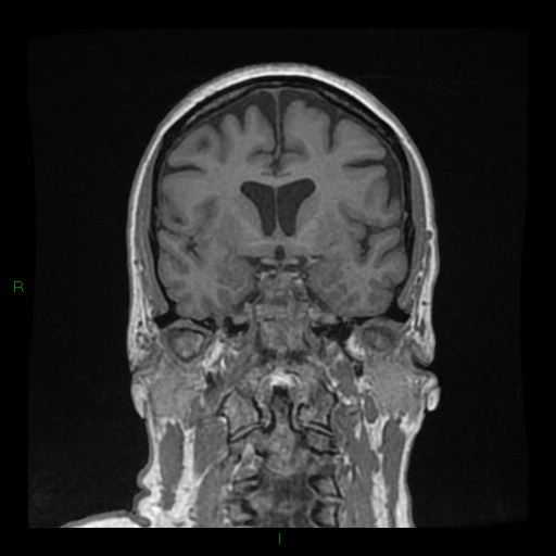 Cerebellar abscess (Radiopaedia 78135-90678 Coronal T1 C+ 71).jpg
