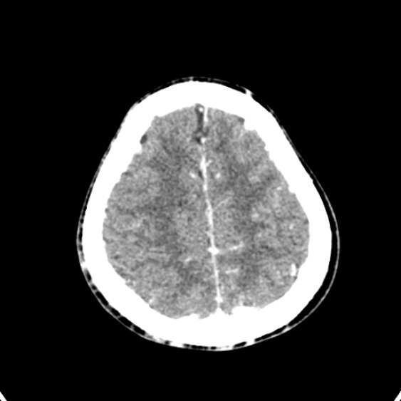 Cerebellar abscess secondary to mastoiditis (Radiopaedia 26284-26412 Axial C+ delayed 130).jpg