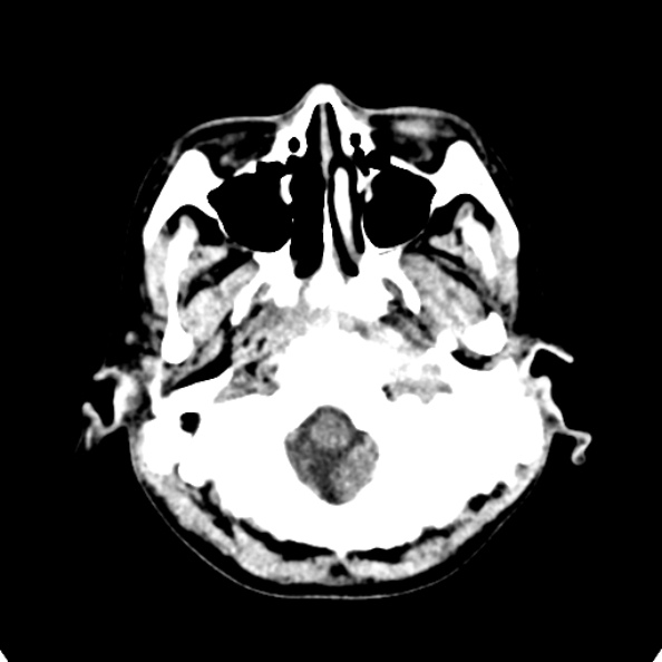 Cerebellar abscess secondary to mastoiditis (Radiopaedia 26284-26412 Axial non-contrast 15).jpg