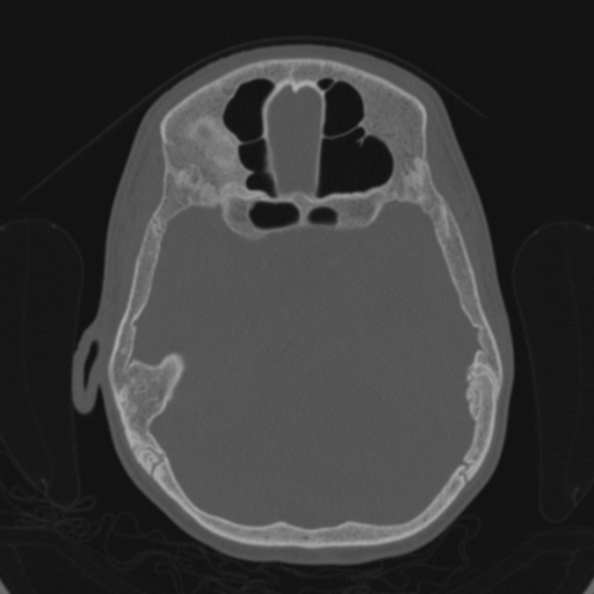 File:Cerebellar abscess secondary to mastoiditis (Radiopaedia 26284-26413 Axial bone window 78).jpg