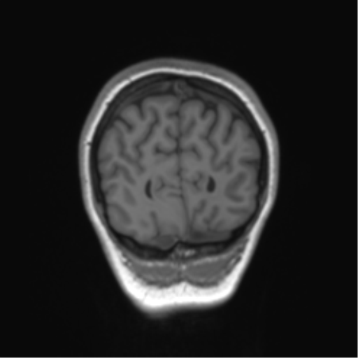 Cerebellar agenesis with hypoplastic pons (pontocerebellar hypoplasia) (Radiopaedia 57224-64138 Coronal T1 18).png
