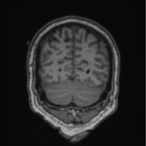 Cerebellar hemangioblastomas and pituitary adenoma (Radiopaedia 85490-101176 Coronal T1 24).png