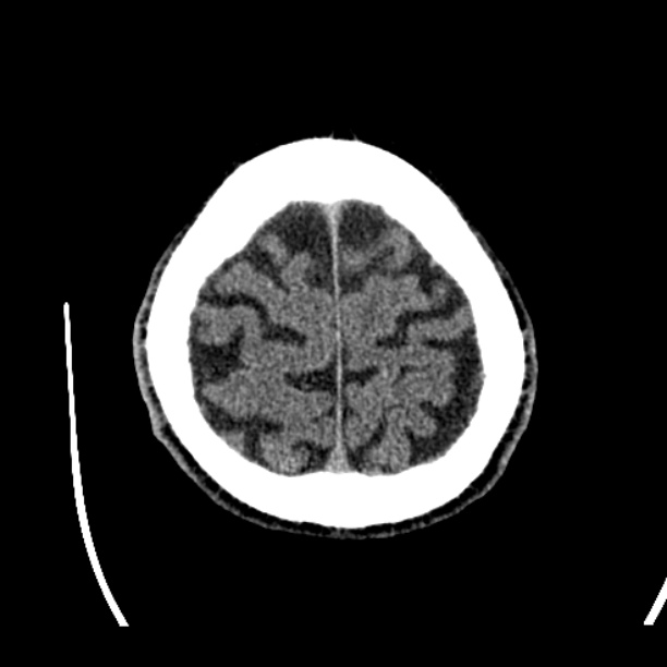 Cerebellar hemorrhage (Radiopaedia 27193-27359 Axial non-contrast 48).jpg