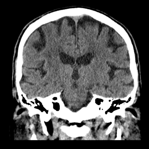 Cerebellar hemorrhage (Radiopaedia 27193-27359 Coronal non-contrast 32).jpg