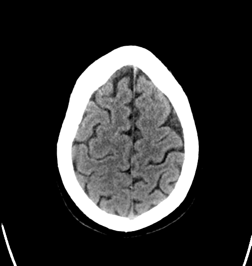 File:Cerebellar infarct due to vertebral artery dissection with posterior fossa decompression (Radiopaedia 82779-97031 Axial non-contrast 27).png
