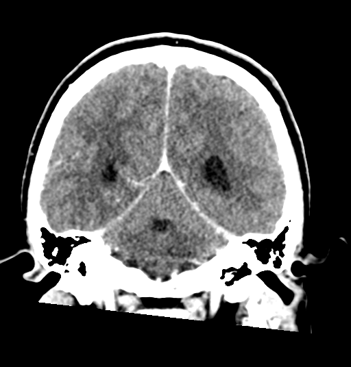 Cerebellar metastases - colorectal adenocarcinoma (Radiopaedia 40947-43652 Coronal C+ 62).png