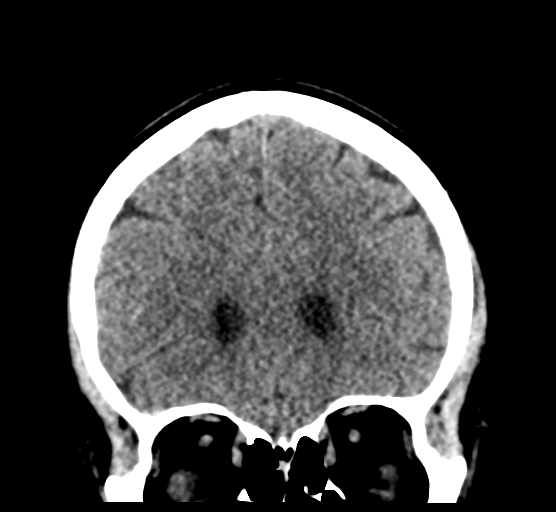 Cerebellar metastases - colorectal adenocarcinoma (Radiopaedia 40947-43652 Coronal non-contrast 30).png