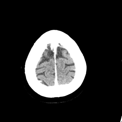 Cerebellar metastasis (Radiopaedia 54578-60812 Axial C+ 45).png