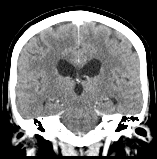 Cerebellar metastasis (Radiopaedia 54578-60812 Coronal C+ 33).png