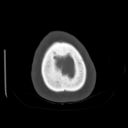 Cerebellar metastasis (cystic appearance) (Radiopaedia 41395-44258 Axial bone window 69).png