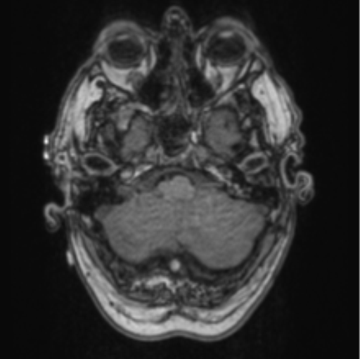 Cerebellar metastasis from lung adenocarcinoma (Radiopaedia 86690-102829 Axial T1 18).png