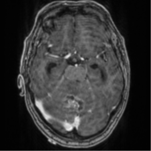 Cerebellar metastasis from lung adenocarcinoma (Radiopaedia 86690-102829 Axial T1 C+ 31).png